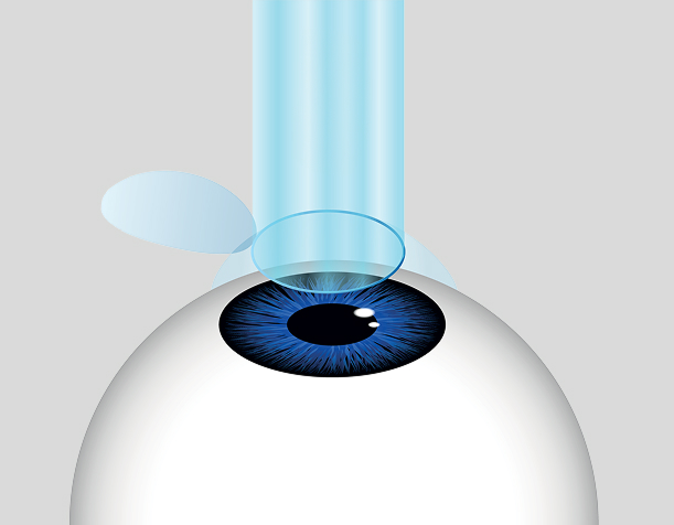 Illustration of the LASIK process
