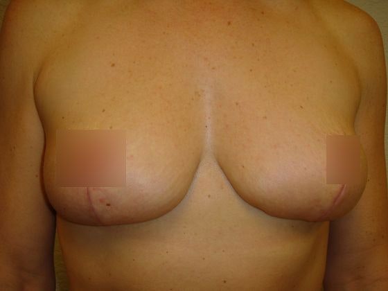 breast lift after