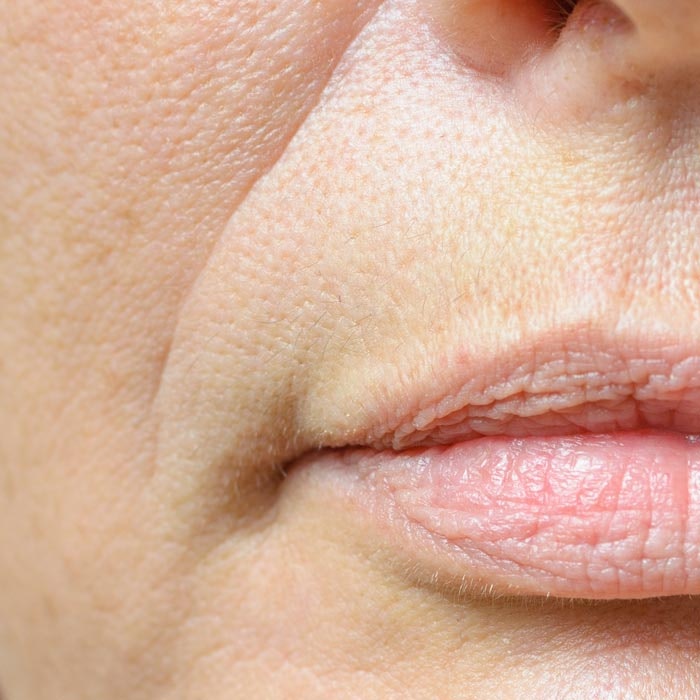 closeup of nasolabial folds