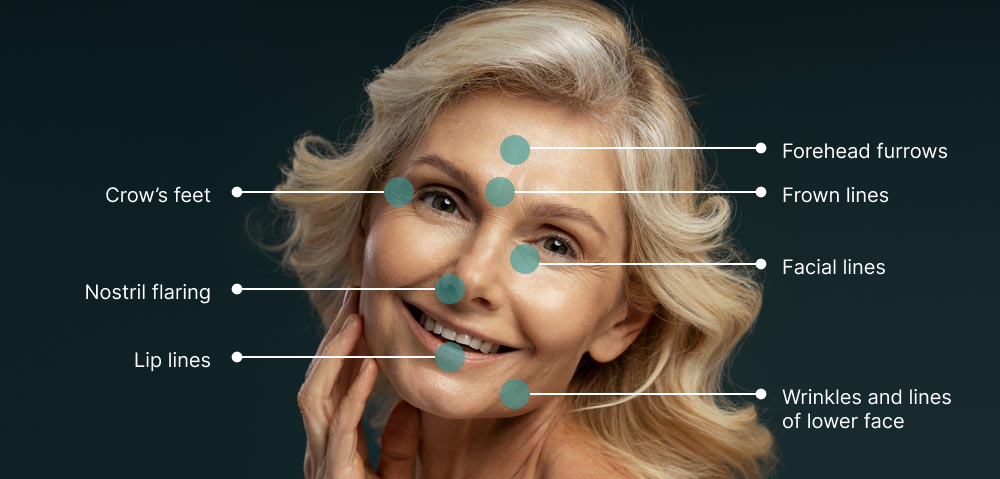 Mature woman's face showing where BOTOX targets: Forehead furrows, Crow's feet, Frown lines, Facial lines, nostril flaring, lip lines, wrinkles and lines of lower face
