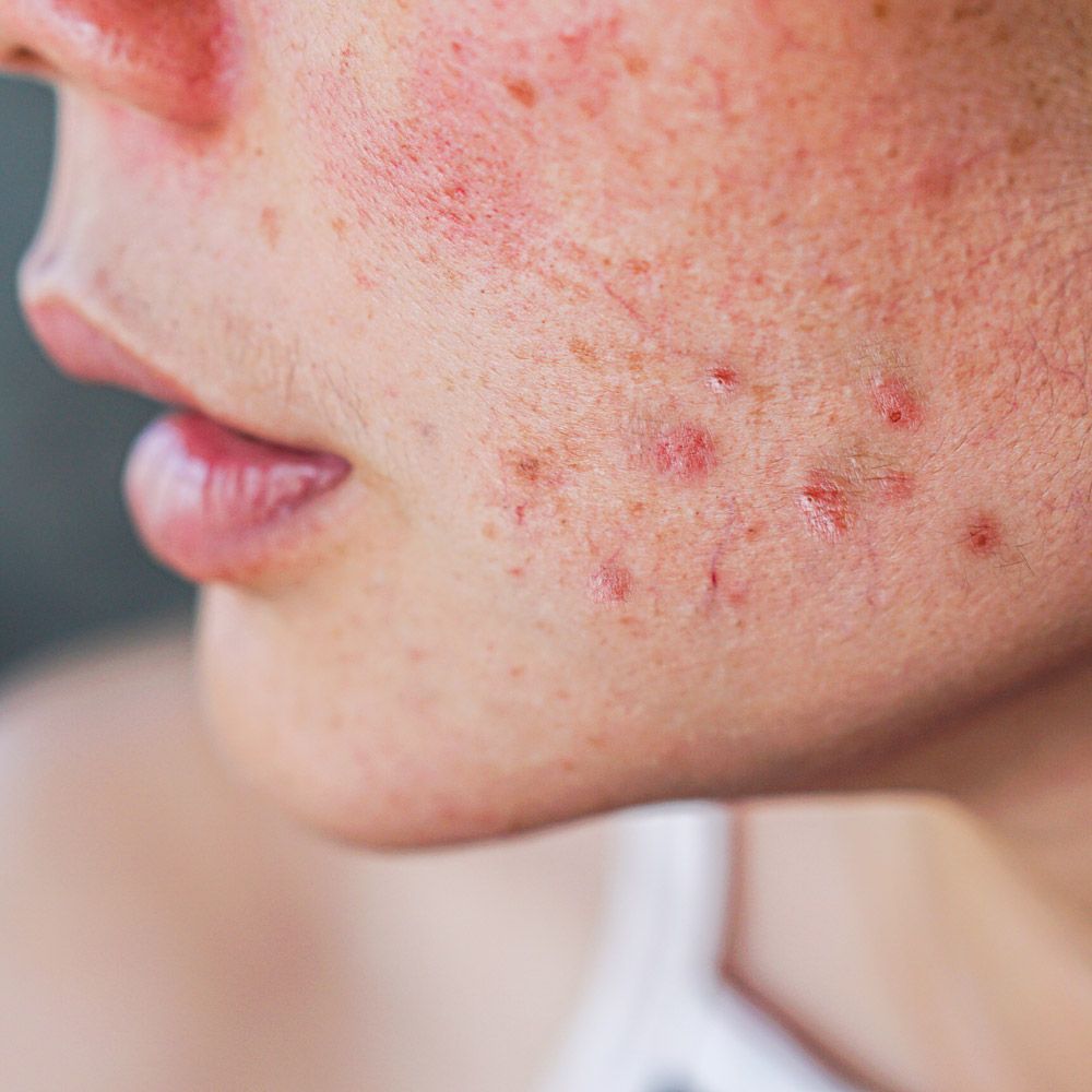 acne-treatment-fullerton-ca-full-spectrum-dermatology