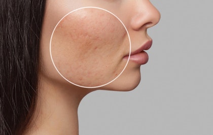 Acne scarring