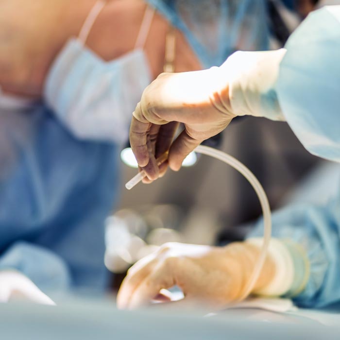 Liposuction procedure