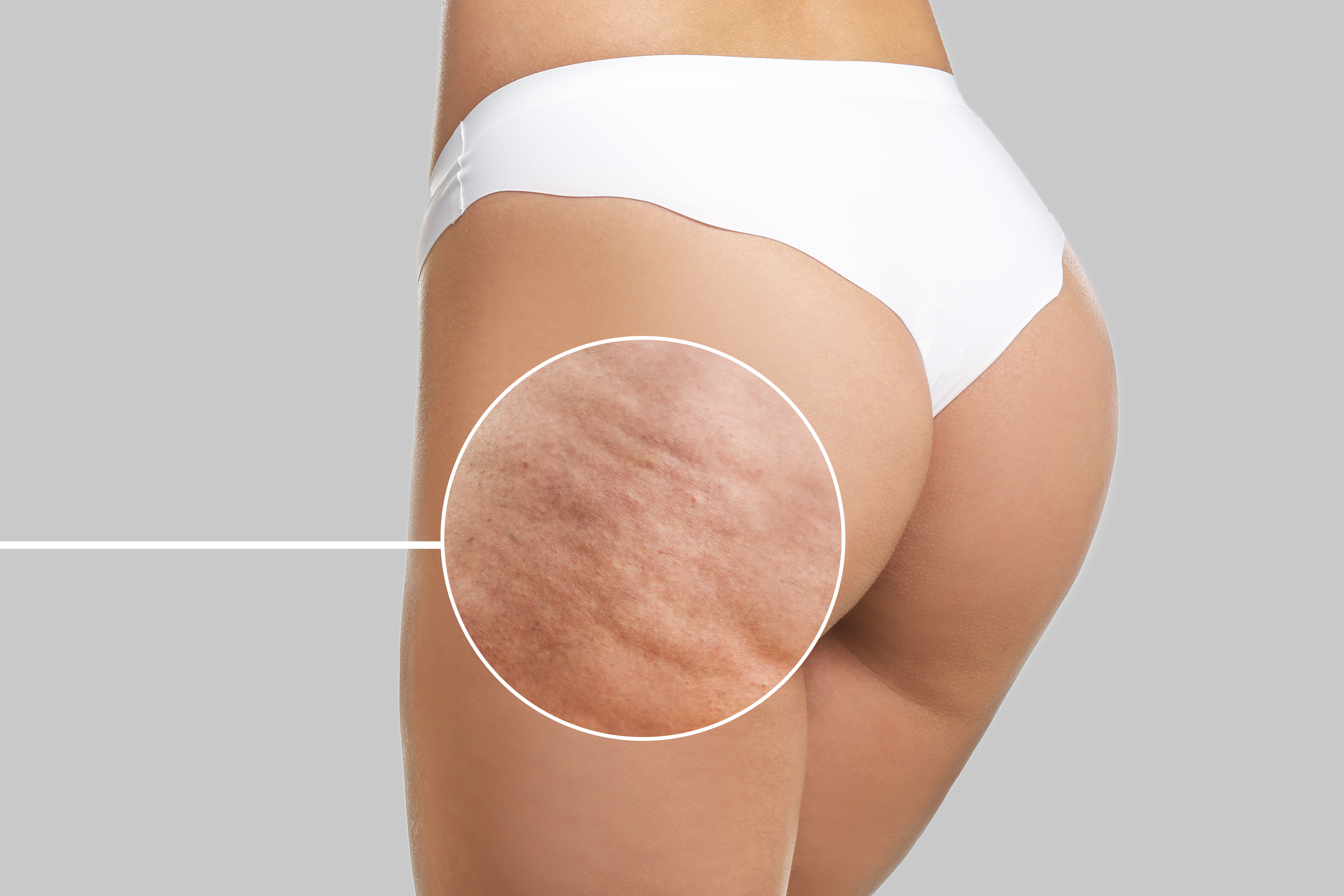 Cellulite on thigh