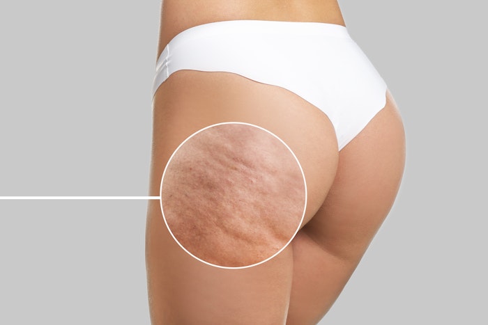 Cellulite on thigh