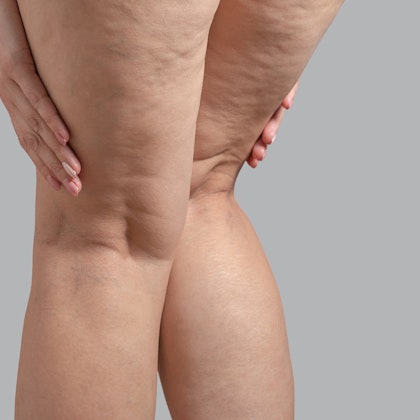 Cellulite on legs