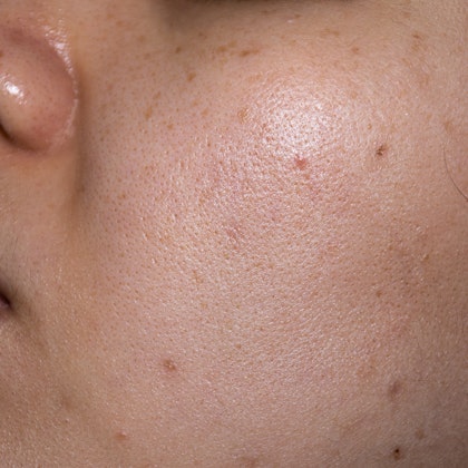 Uneven tone on cheek