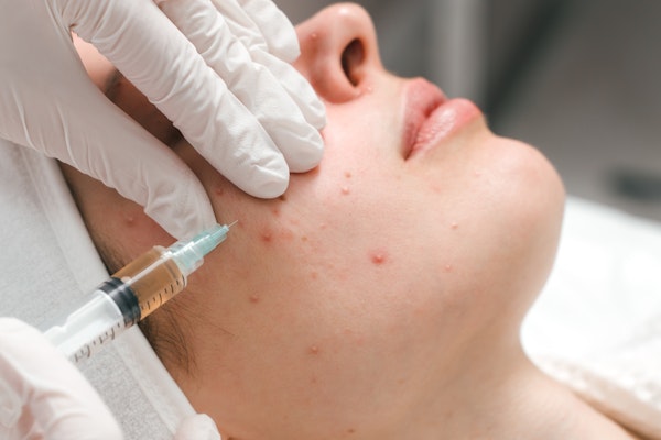 person receiving acne treatment