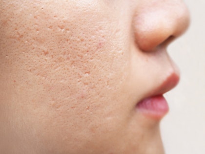 Close up of deep acne scars
