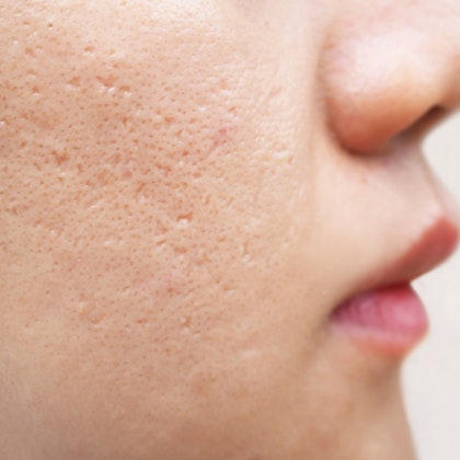 Close up of deep acne scars