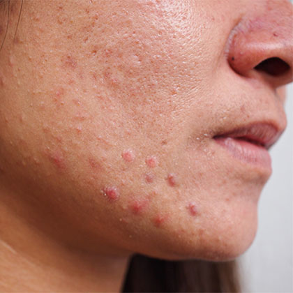Raised acne scars