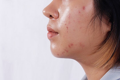 Close up of pink and red spots