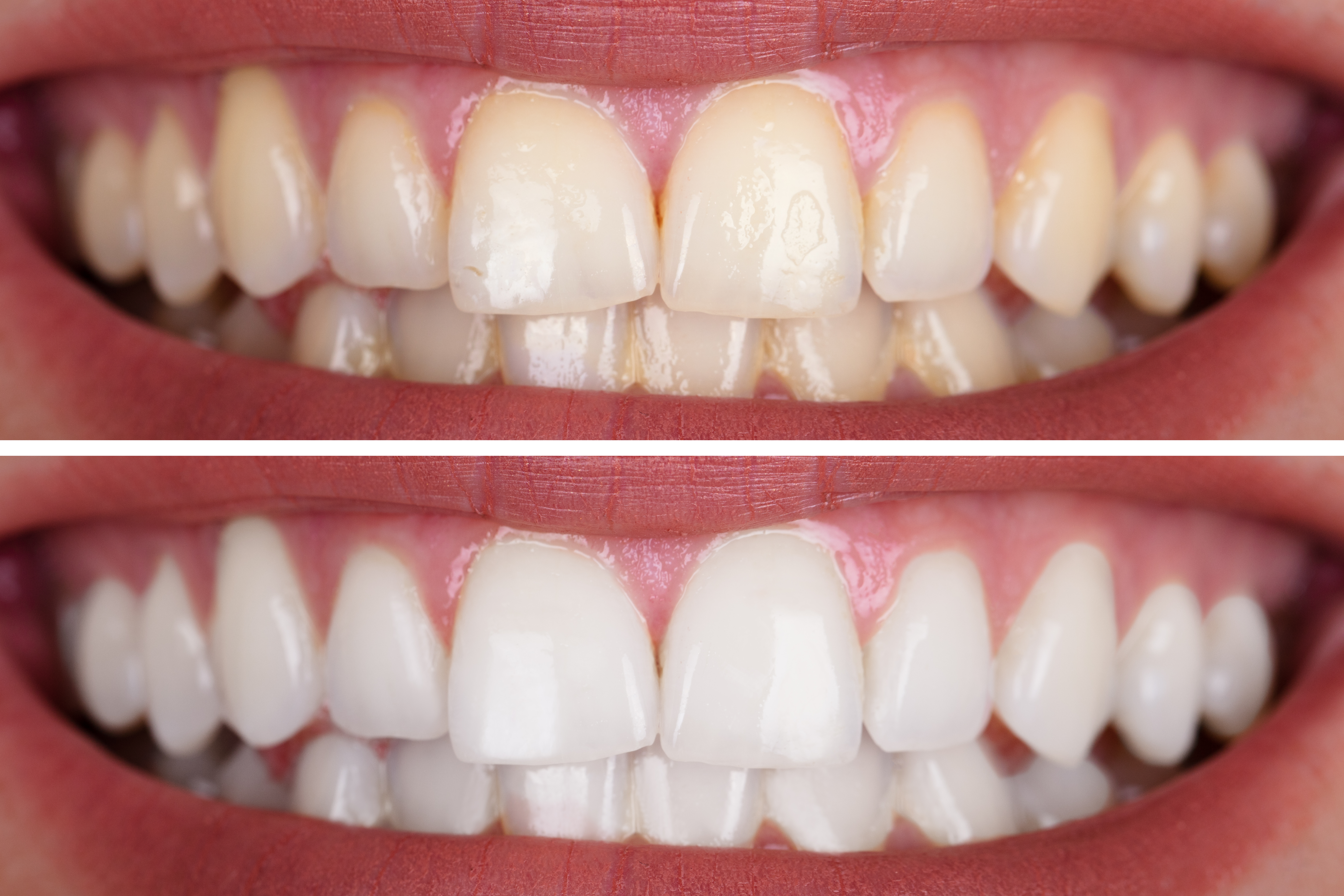 Teeth Whitening, before and after