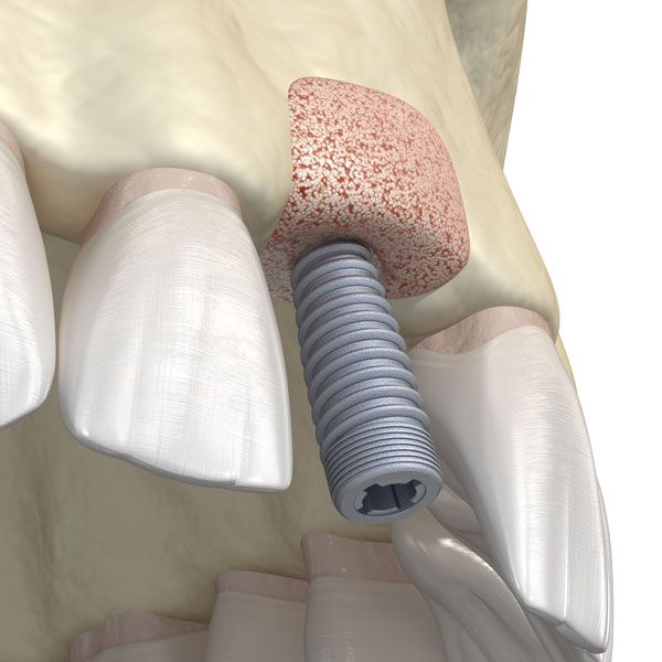 Bone Grafting