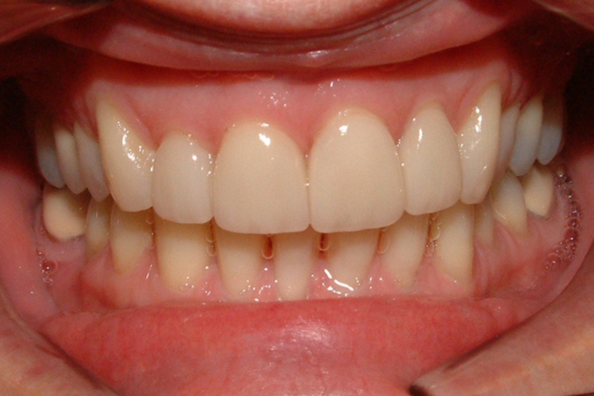 After Veneers