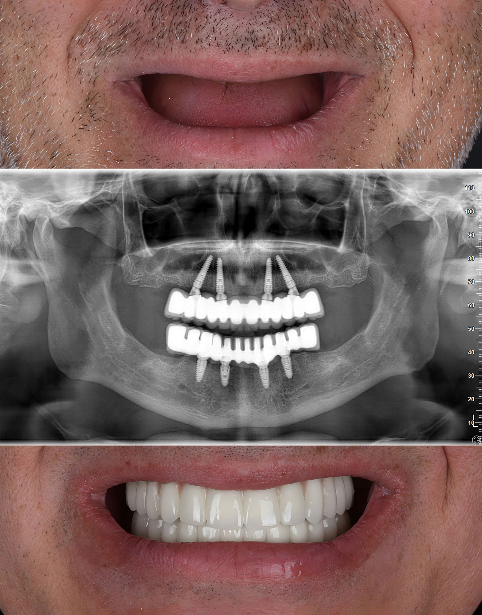 all-on-4 patient collage