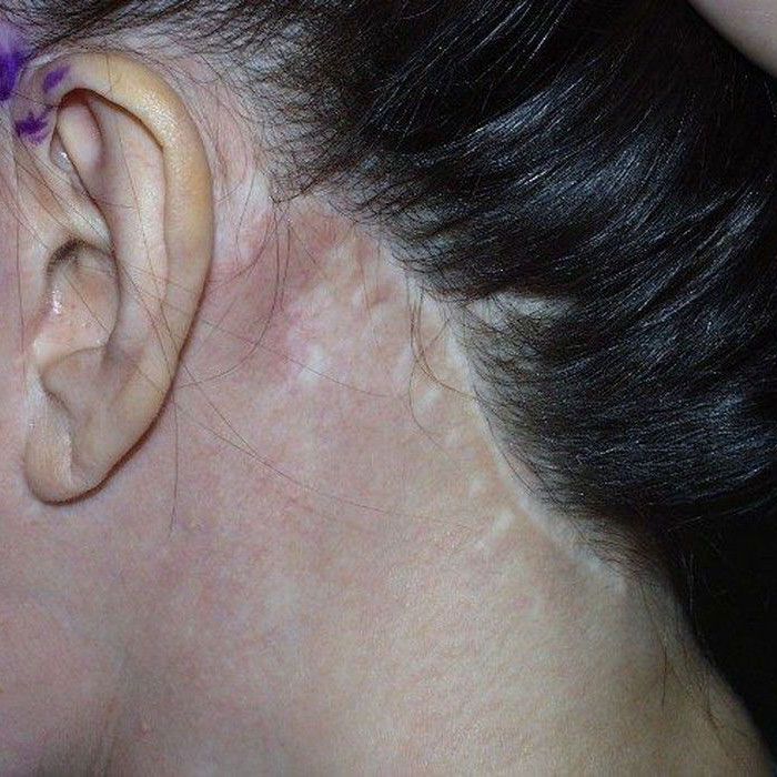 Facelift scar along hairline
