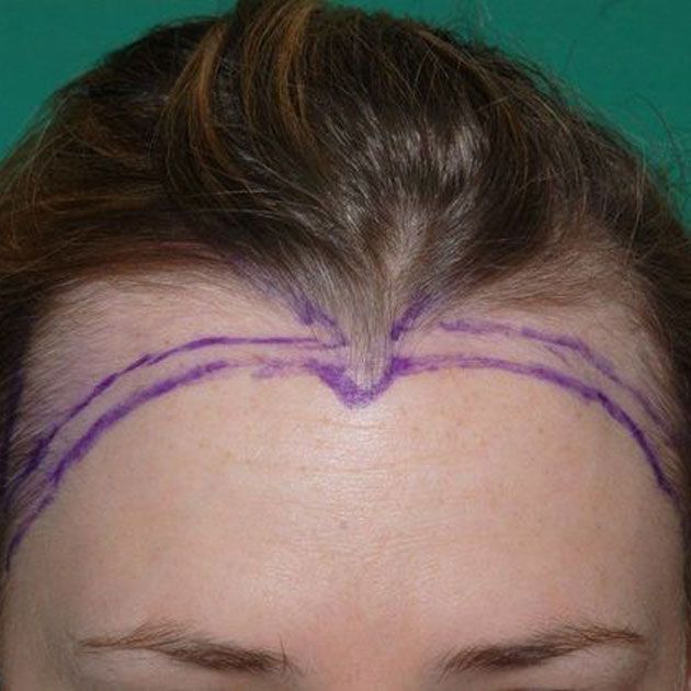 Woman's high forehead marked with marker