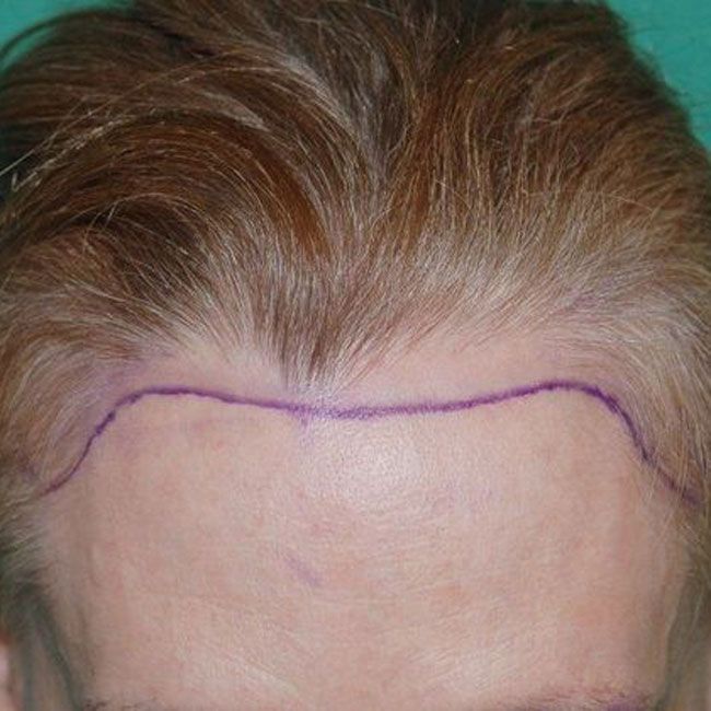 Woman's high forehead marked with marker
