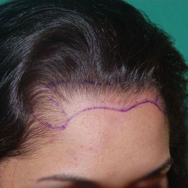Woman's high forehead marked with marker