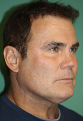 Before face and neck lifts