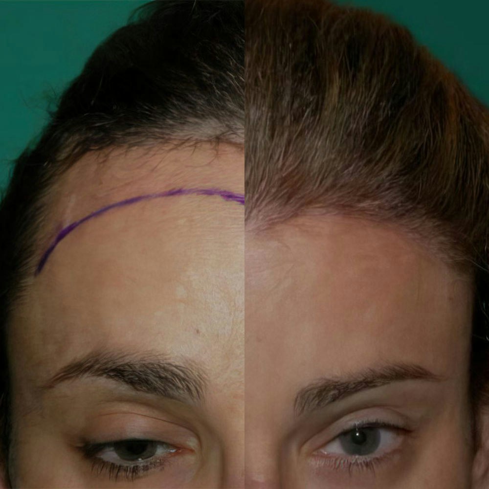 Before and after FUE Hair Transplant