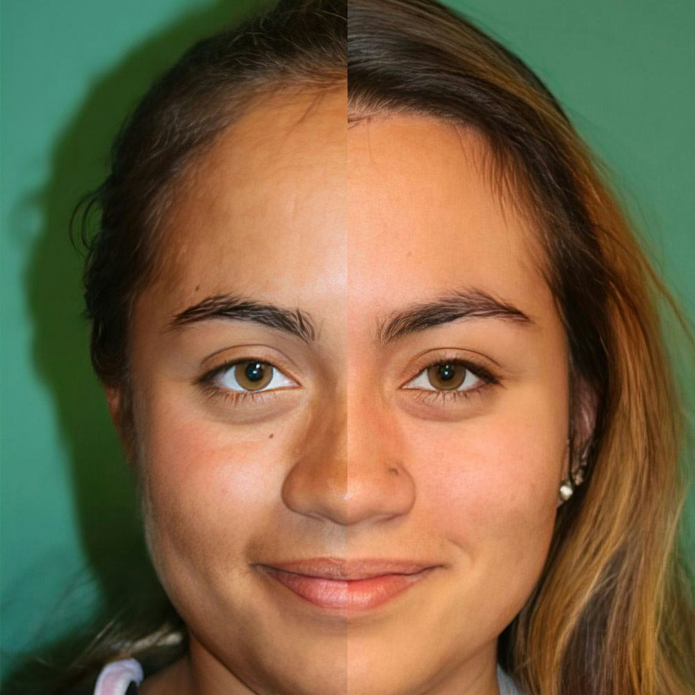 Case 5 before and after forehead reduction