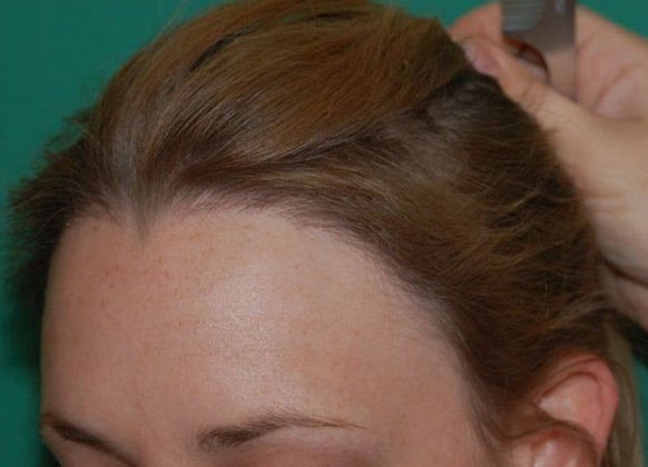 After Female Restoration