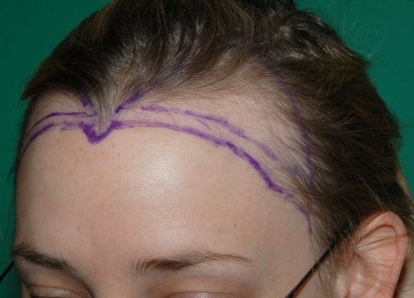 Before Female Restoration