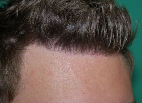 Postop Right View 1 With Gel in Hair