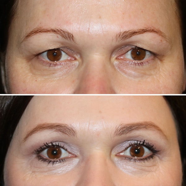 Non-Surgical Eye Lifts in Chicago  Under Eye Bags Removal & Treatment