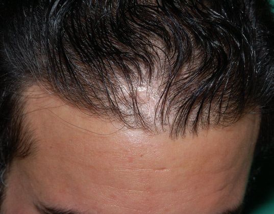 Patient before 2,188 Graft Hairline Repair Procedure