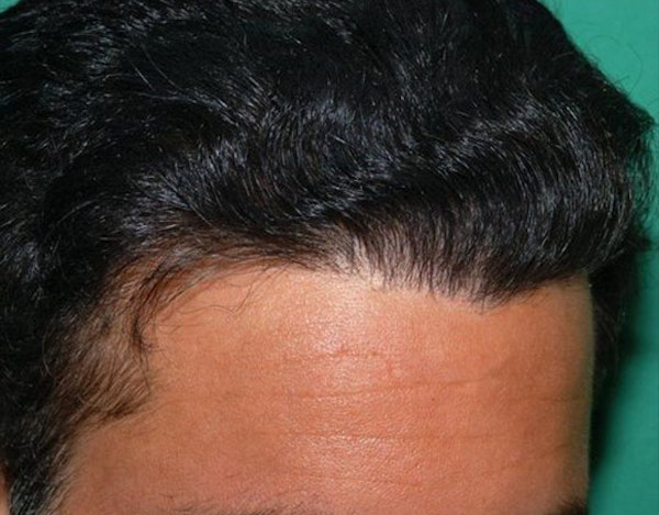 Man's full head of hair after hair restoration treatment