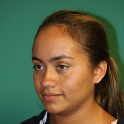 Case 5 before Hairline Lowering Surgery