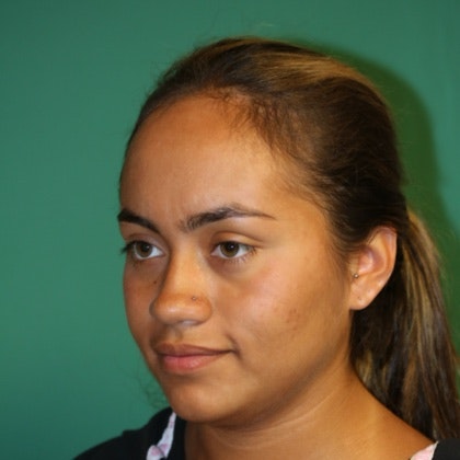 Case 5 before Hairline Lowering Surgery