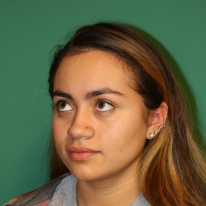 Case 5 after Hairline Lowering Surgery