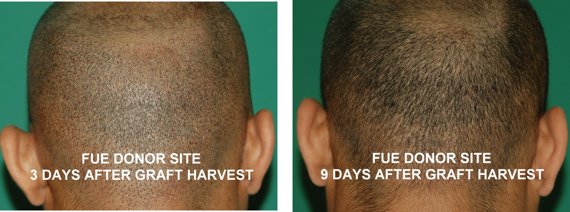 Donor site after FUE