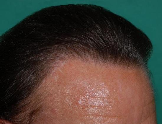 Dr. Raymond Konior's patient after hair restoration
