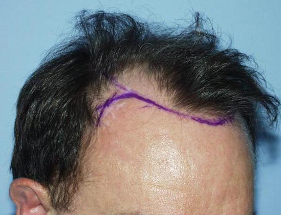 Dr. Raymond Konior's patient before hair restoration