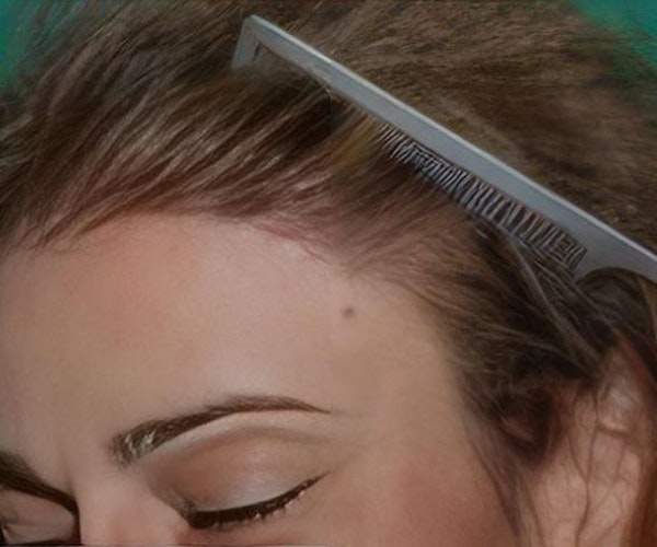 Patient's full head of hair after hair restoration treatment