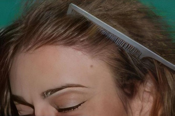 Patient's full head of hair after hair restoration treatment