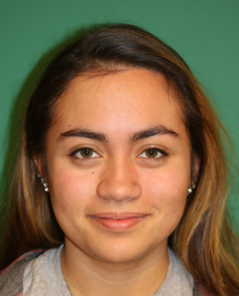 Chicago Hair Institute Patient After Hairline Lowering