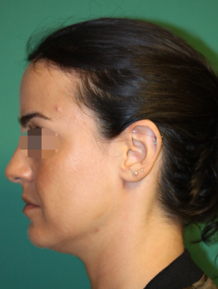 Chicago Hair Institute Patient Before Hairline Lowering