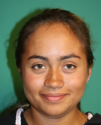 Chicago Hair Institute Patient Before Hairline Lowering