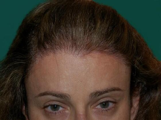 hairline restored with hair restoration