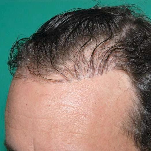 Poor results after hair transplant surgery
