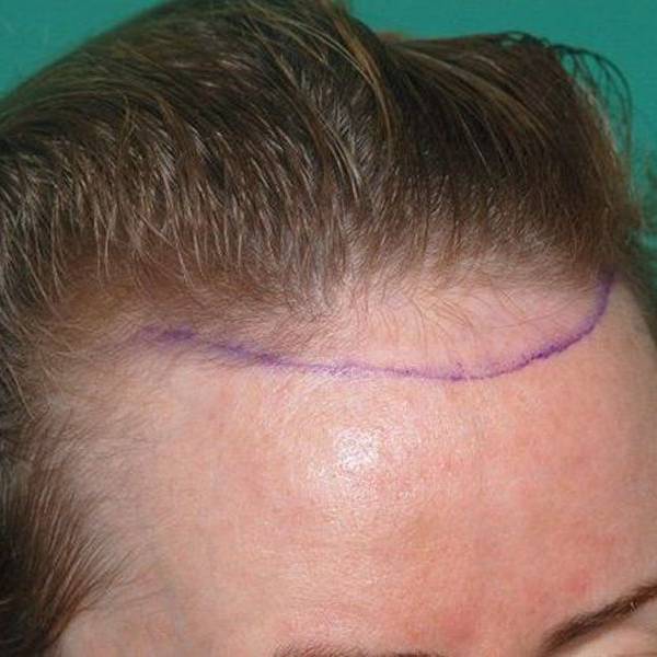 surgical marking for hair restoration on a woman