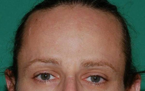 Before Feminization with Staged Advancement and Follicular-Unit Grafting