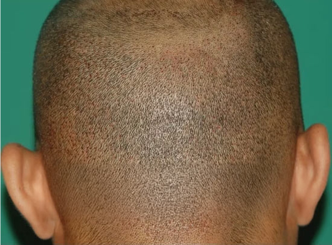 FUE patient's donor site with short hair