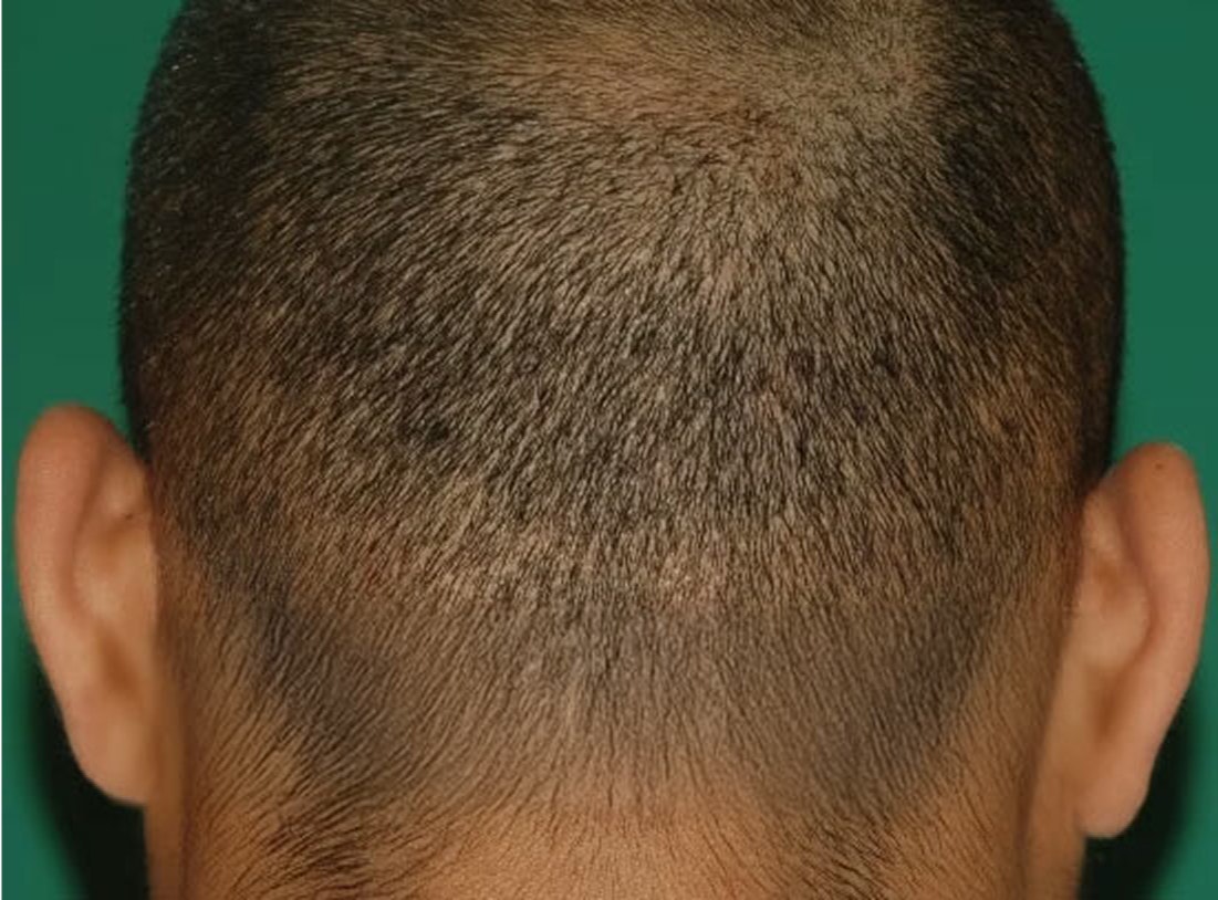 FUE patient's donor site with longer hair